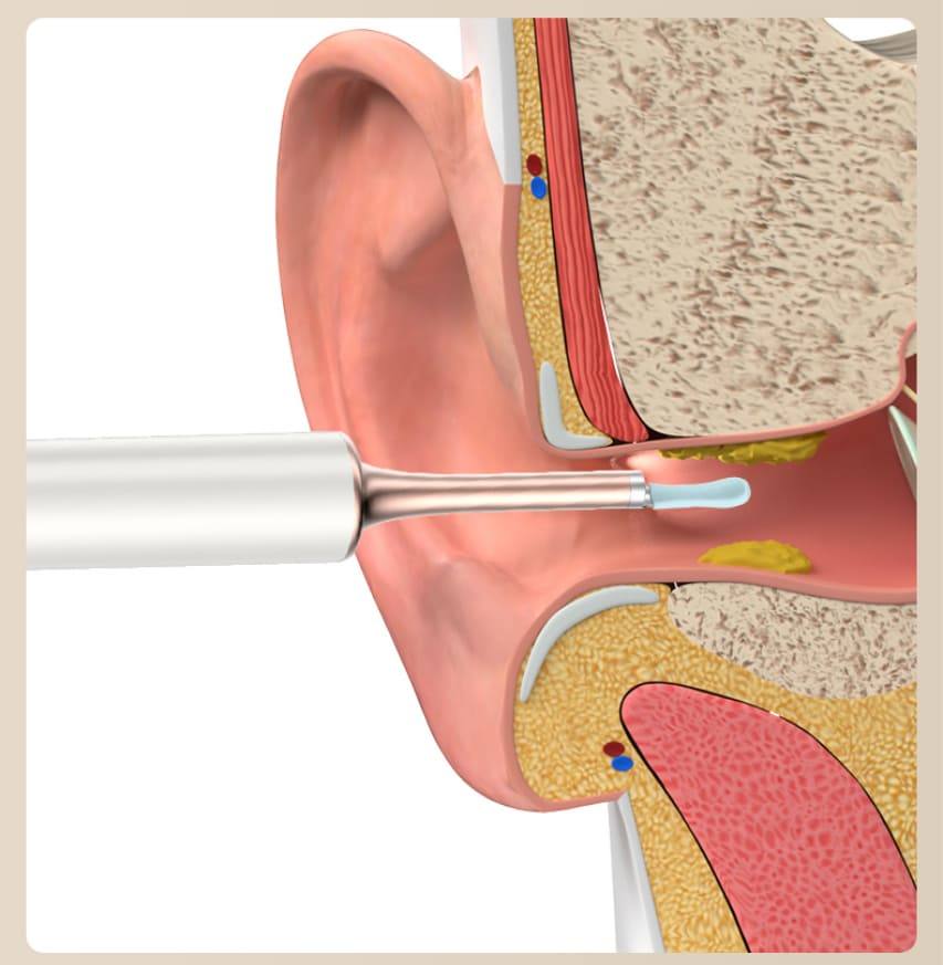 Ohrenschmalz-Entferner - Reinigung des Ohres